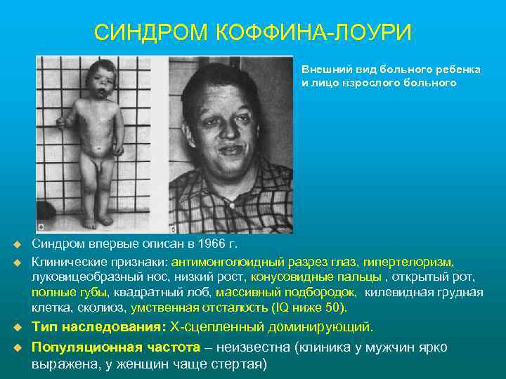 СИНДРОМ КОФФИНА-ЛОУРИ Внешний вид больного ребенка и лицо взрослого больного u u Синдром впервые