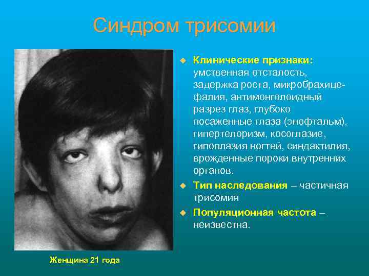 Синдром трисомии u u u Женщина 21 года Клинические признаки: умственная отсталость, задержка роста,