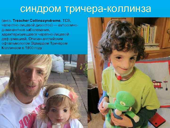 синдром тричера-коллинза (англ. Treacher Collinssyndrome, TCS, челюстно-лицевой дизостоз) — аутосомнодоминантное заболевание, характеризующееся черепно-лицевой деформацией.