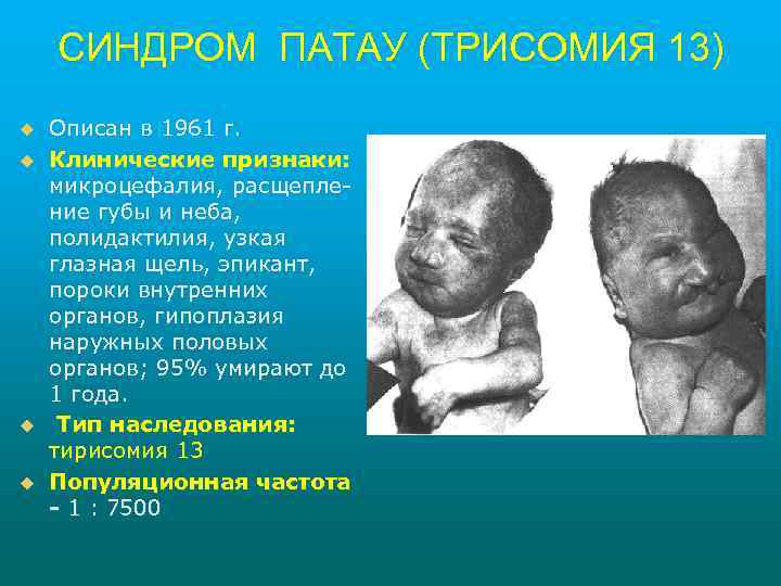 СИНДРОМ ПАТАУ (ТРИСОМИЯ 13) u u Описан в 1961 г. Клинические признаки: микроцефалия, расщепление