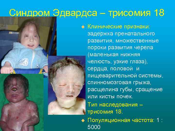 Синдром Эдвардса – трисомия 18 u u u Клинические признаки: задержка пренатального развития, множественные