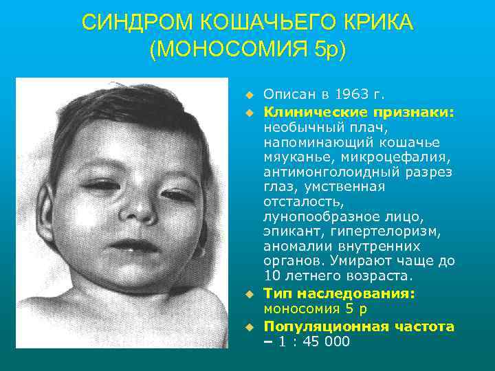 СИНДРОМ КОШАЧЬЕГО КРИКА (МОНОСОМИЯ 5 р) u u Описан в 1963 г. Клинические признаки: