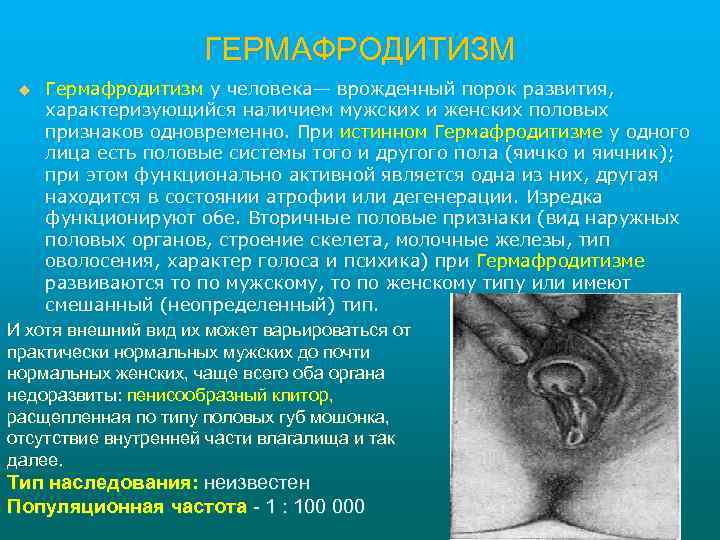 ГЕРМАФРОДИТИЗМ Гермафродитизм у человека— врожденный порок развития, характеризующийся наличием мужских и женских половых признаков