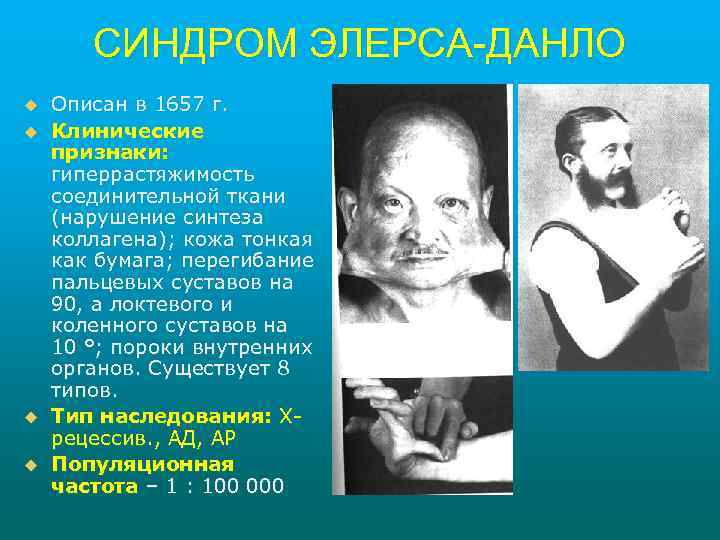 СИНДРОМ ЭЛЕРСА-ДАНЛО u u Описан в 1657 г. Клинические признаки: гиперрастяжимость соединительной ткани (нарушение