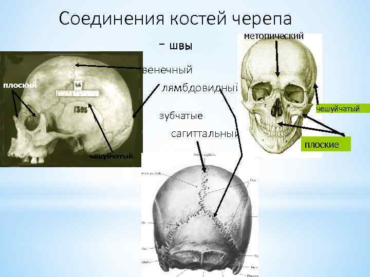 Соединения костей черепа метопический - швы венечный лямбдовидный плоский зубчатые сагиттальный чешуйчатый плоские 