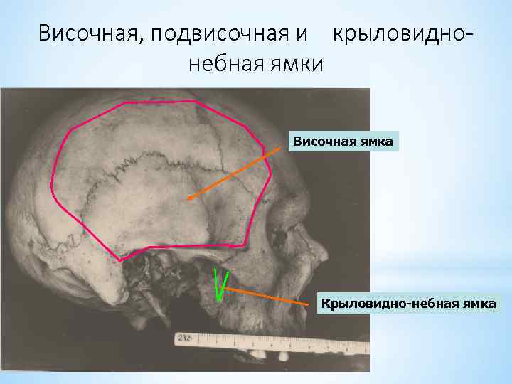 Височная, подвисочная и крыловиднонебная ямки Височная ямка Крыловидно-небная ямка 