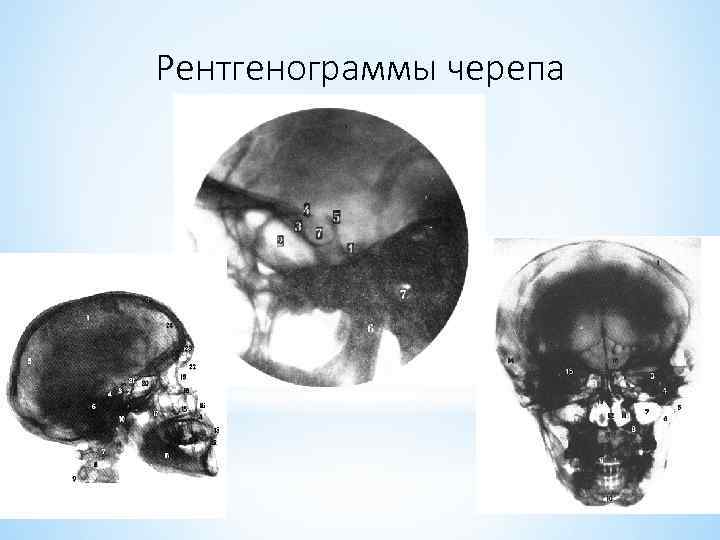 Рентгенограммы черепа 