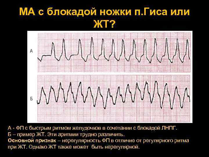 МА с блокадой ножки п. Гиса или ЖТ? А - ФП с быстрым ритмом