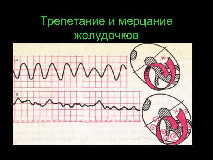 Трепетание и мерцание желудочков 