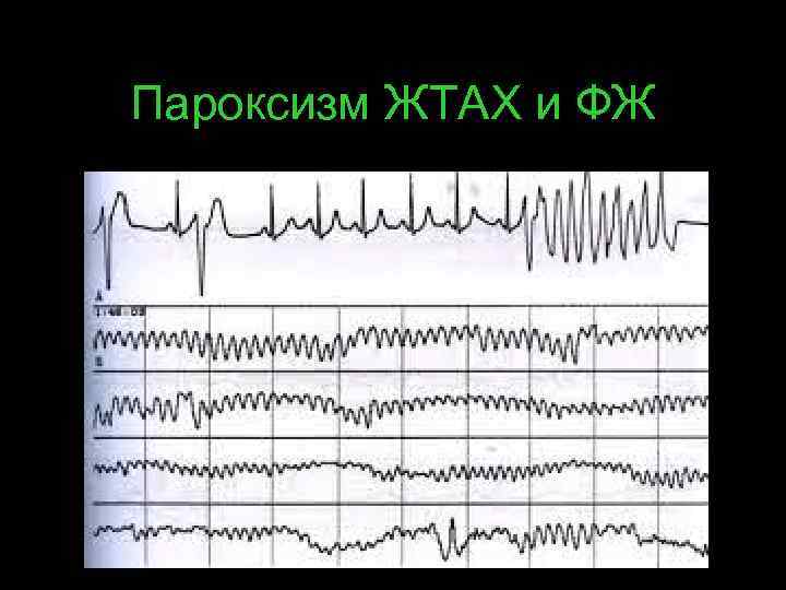 Пароксизм ЖТАХ и ФЖ 