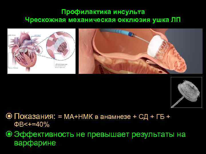 Профилактика инсульта Чрескожная механическая окклюзия ушка ЛП Показания: = МА+НМК в анамнезе + СД