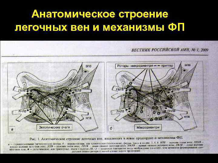 Анатомическое строение легочных вен и механизмы ФП 