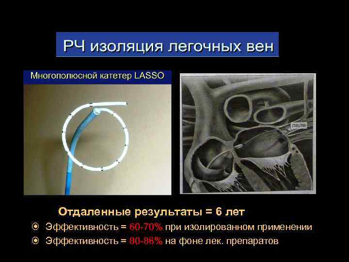 Отдаленные результаты = 6 лет Эффективность = 60 -70% при изолированном применении 60 -70%