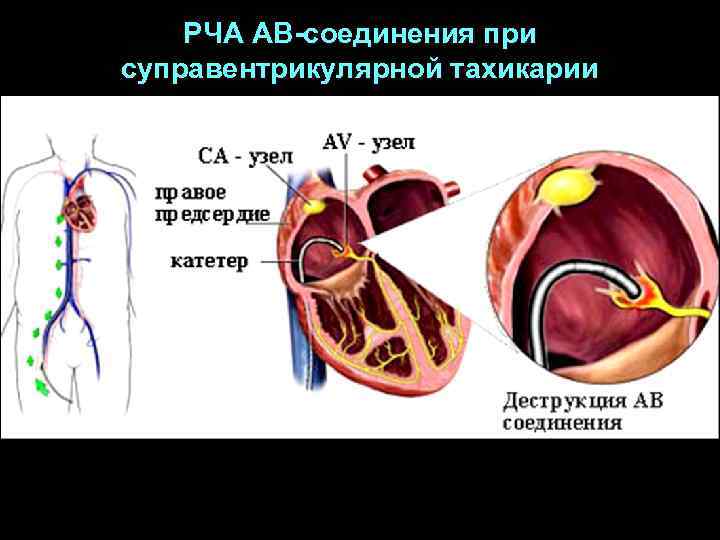 РЧА АВ-соединения при суправентрикулярной тахикарии 