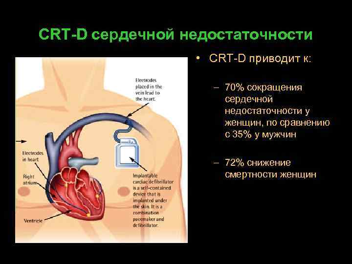 CRT-D сердечной недостаточности • CRT-D приводит к: – 70% сокращения сердечной недостаточности у женщин,