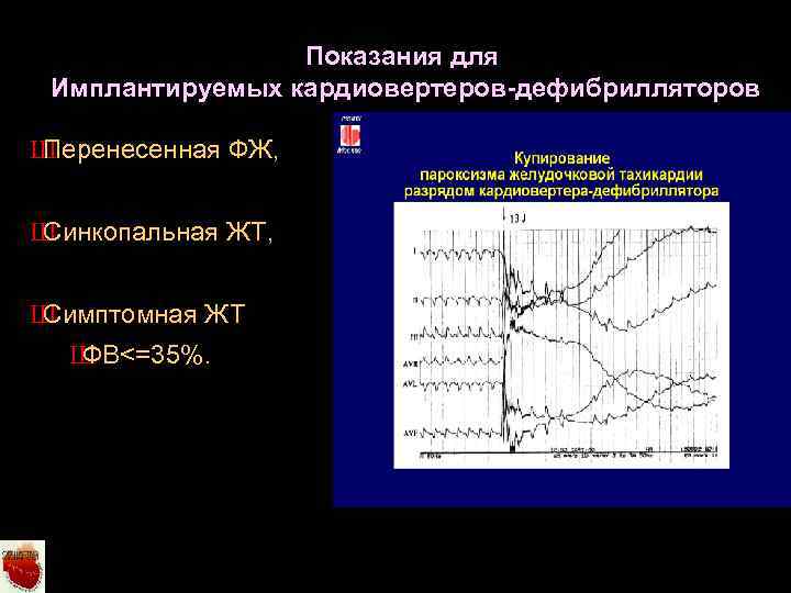 Показания для Имплантируемых кардиовертеров-дефибрилляторов Ш Перенесенная ФЖ, Ш Синкопальная ЖТ, Ш Симптомная ЖТ Ш