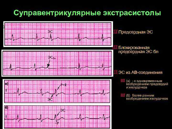 Cуправентрикулярные экстрасистолы Ш Предсердная ЭС Ш Блокированная предсердная ЭС бл Ш ЭС из АВ-соединения