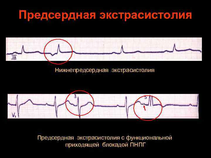 Предсердная экстрасистолия. Нарушение ритма предсердная экстрасистолия. Нижнепредсердная экстрасистолия. Групповая предсердная экстрасистолия. Функциональные экстрасистолы.