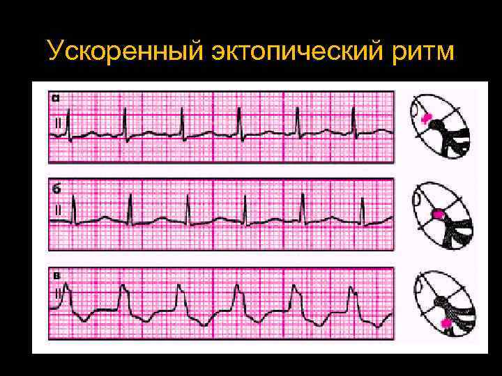 Эктопический ритм. Ускоренный эктопический нижнепредсердный ритм. Ускоренный эктопический ритм на ЭКГ. Ускоренный нижнепредсердный ритм с ЧСС. Эктопический нерегулярный ритм.