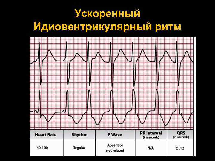 Желудочковый ритм