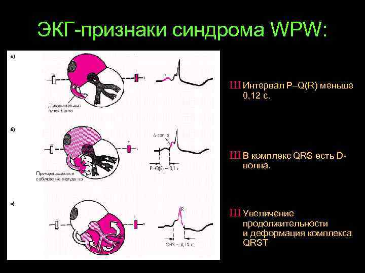 Экг синдромы. ВПВ синдром на ЭКГ. Wpw синдром ЭКГ признаки. ЭКГ критерии синдрома wpw. ВПВ на ЭКГ признаки.