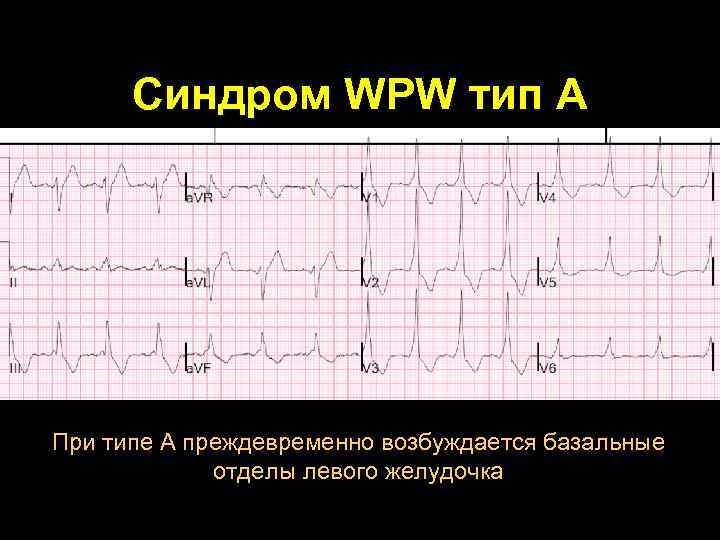 Синдром впв презентация