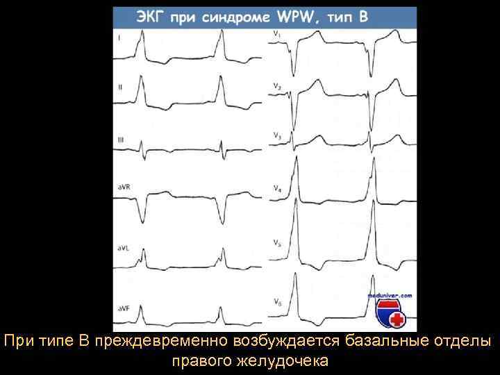 При типе В преждевременно возбуждается базальные отделы правого желудочека 