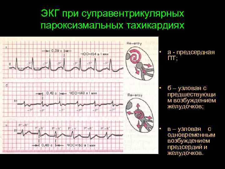 ЭКГ при суправентрикулярных пароксизмальных тахикардиях • а - предсердная ПТ; • б – узловая