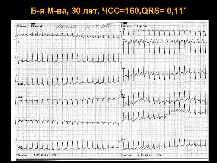 Б-я М-ва, 30 лет, ЧСС=160, QRS= 0, 11” 