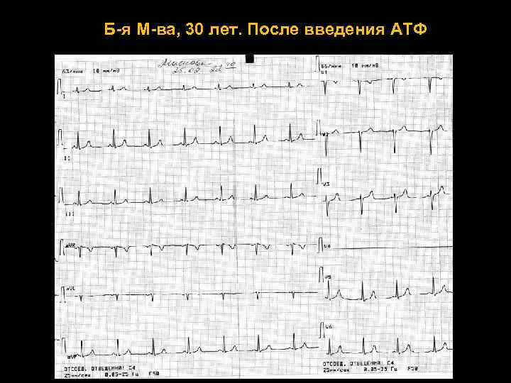 Б-я М-ва, 30 лет. После введения АТФ 