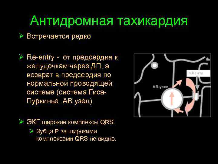 Антидромная тахикардия Ø Встречается редко Ø Re-entry - от предсердия к желудочкам через ДП,