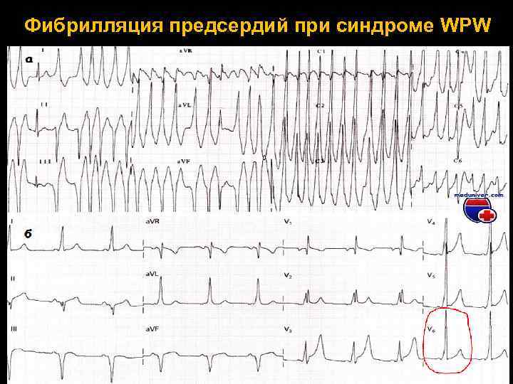 Фибрилляция предсердий при синдроме WPW 