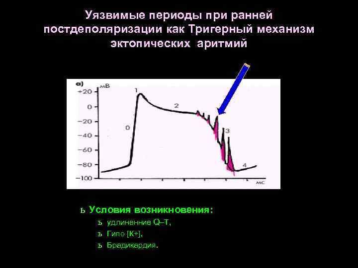 Уязвимые периоды при ранней постдеполяризации как Тригерный механизм эктопических аритмий ь Условия возникновения: ь