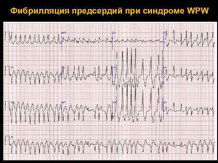 Фибрилляция предсердий при синдроме WPW 
