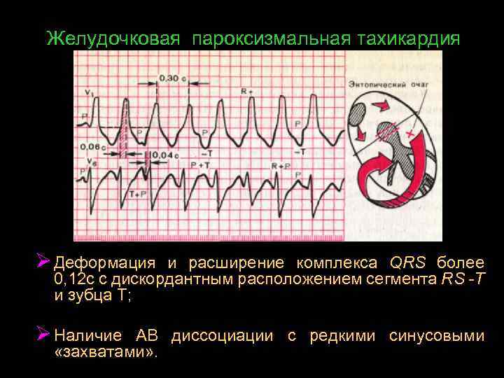 Пароксизмальная желудочковая тахикардия карта вызова смп