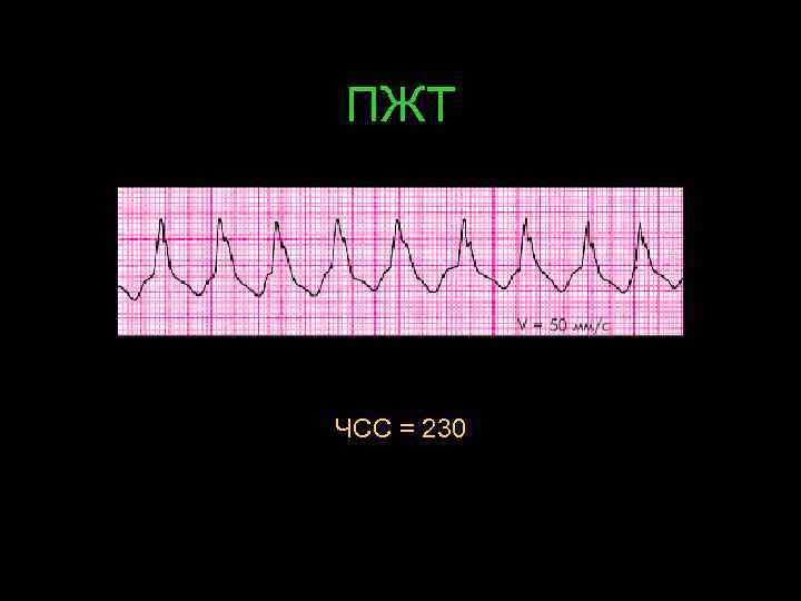 ПЖТ ЧСС = 230 