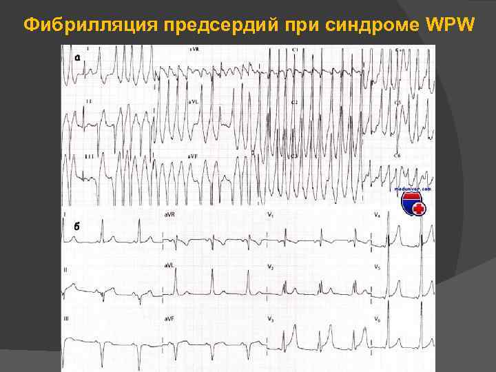 Фибрилляция предсердий при синдроме WPW 