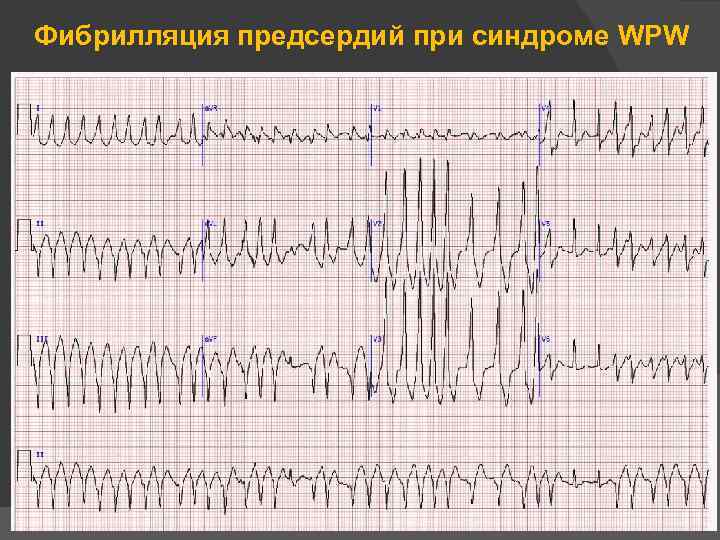 Фибрилляция предсердий при синдроме WPW 