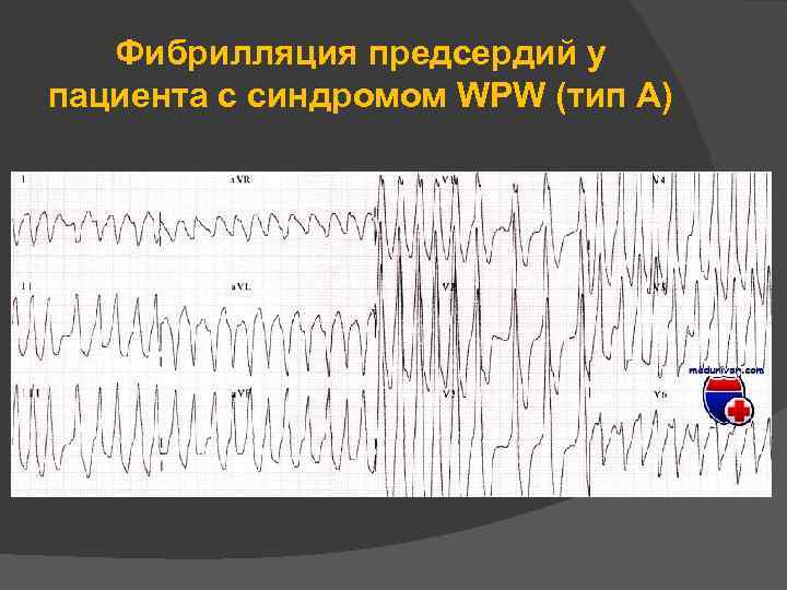 Фибрилляция предсердий у пациента с синдромом WPW (тип А) 