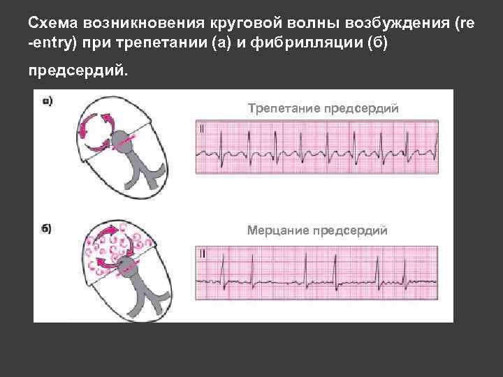 Схема возникновения круговой волны возбуждения (re -entry) при трепетании (а) и фибрилляции (б) предсердий.