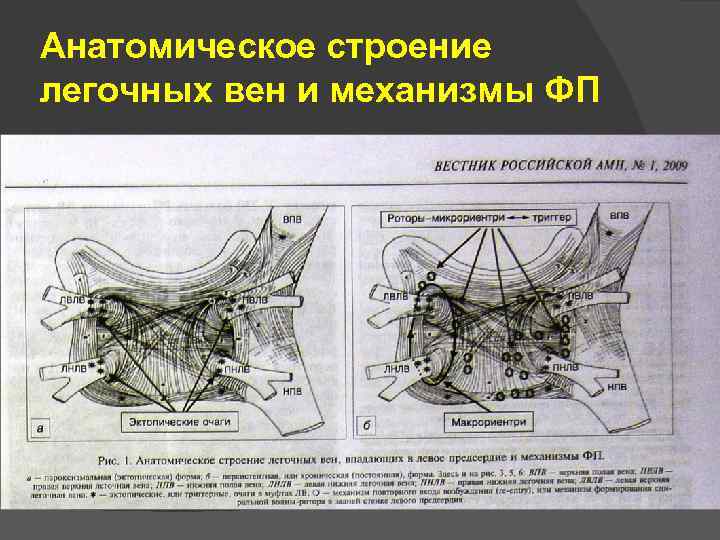 Анатомическое строение легочных вен и механизмы ФП 