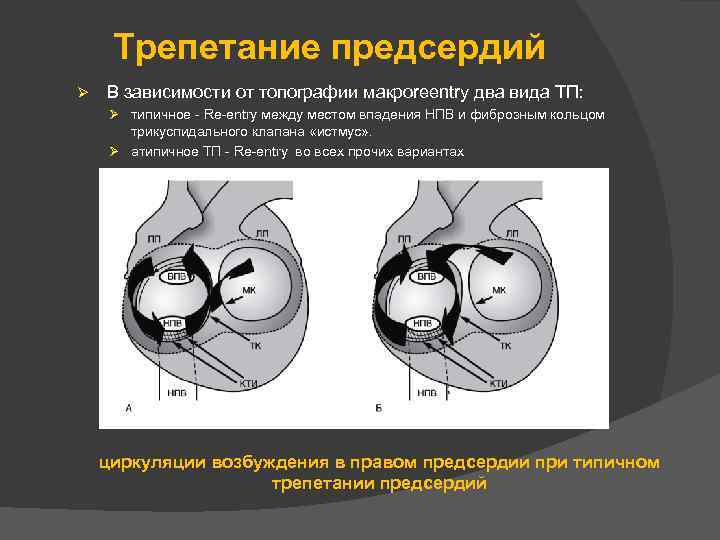 Трепетание предсердий Ø В зависимости от топографии макроreentry два вида ТП: Ø типичное -