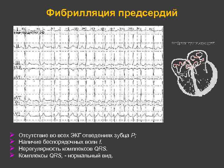 Фибрилляция предсердий Ø Ø Отсутствие во всех ЭКГ отведениях зубца Р; Наличие беспорядочных волн