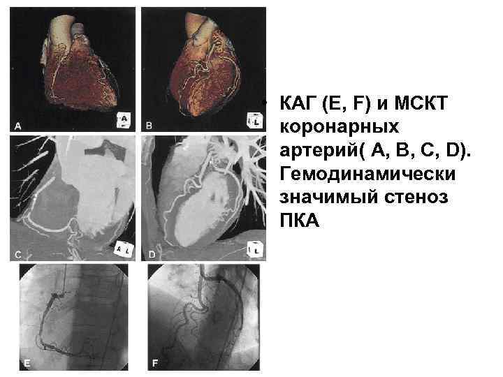  • КАГ (E, F) и МСКТ коронарных артерий( A, B, C, D). Гемодинамически