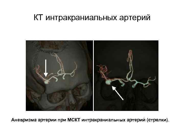 КТ интракраниальных артерий Аневризма артерии при МСКТ интракраниальных артерий (стрелки). 