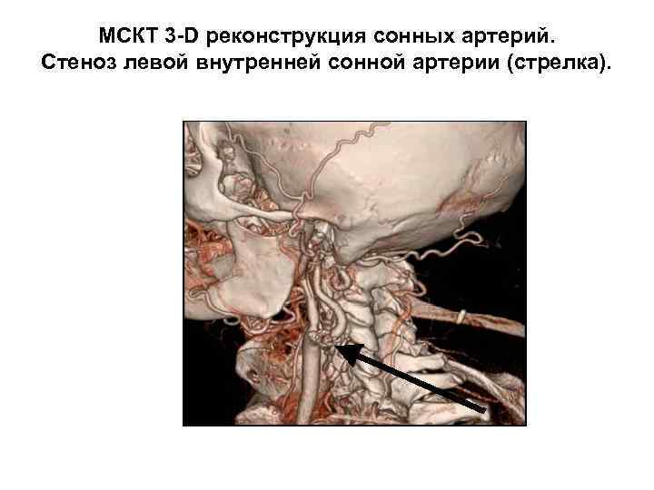 МСКТ 3 -D реконструкция сонных артерий. Стеноз левой внутренней сонной артерии (стрелка). 