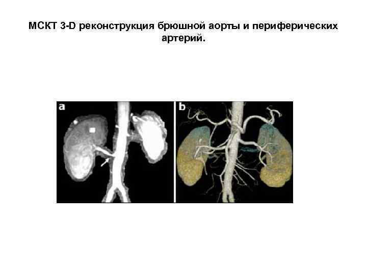 МСКТ 3 -D реконструкция брюшной аорты и периферических артерий. 