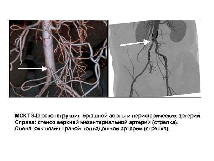 МСКТ 3 -D реконструкция брюшной аорты и периферических артерий. Справа: стеноз верхней мезентериальной артерии