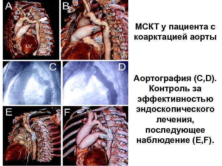  МСКТ у пациента с коарктацией аорты Аортография (С, D). Контроль за эффективностью эндоскопического