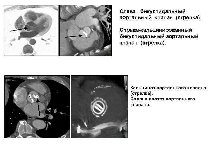 Слева - бикуспидальный аортальный клапан (стрелка). Справа-кальцинированный бикуспидальный аортальный клапан (стрелка). Кальциноз аортального клапана
